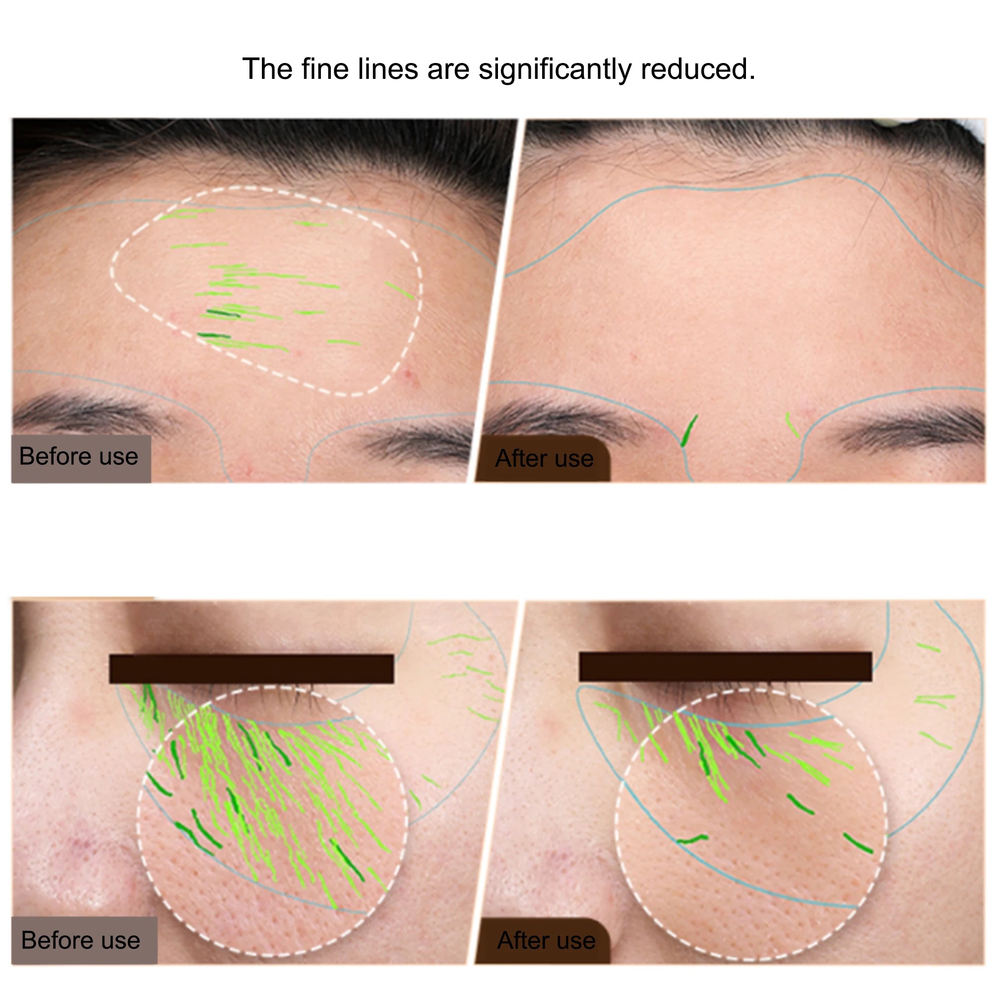 EMS Facial Body Radio Frequency Machine Skin